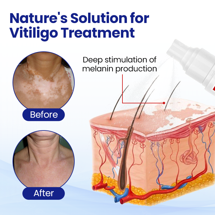Cavebit® Skin Pigment Restoring Spray - 100% Natural & Steroid-Free